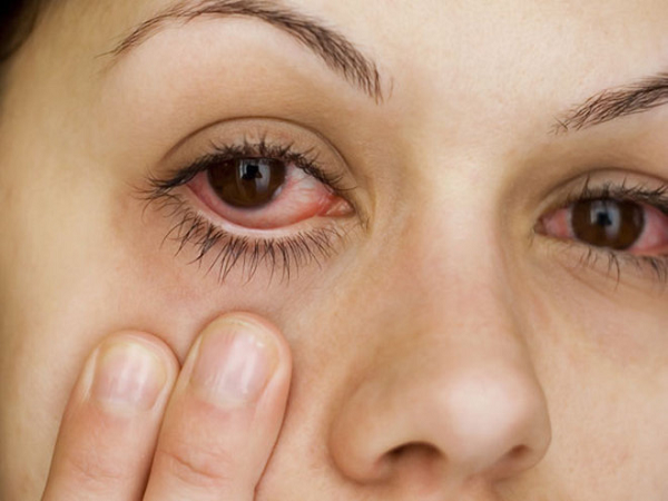 Bệnh đau mắt đỏ do nhiều nguyên nhân gây nên