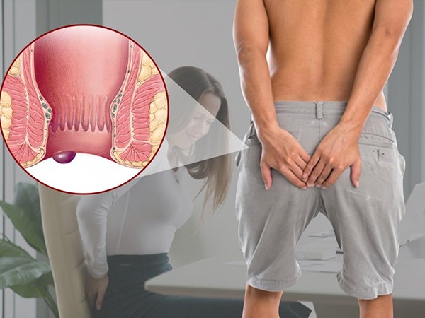 Bài tập kegel cho bệnh trĩ tại nhà hướng dẫn chi tiết