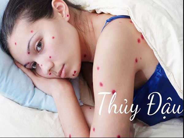 Thủy đậu có lây sang người lớn không?
